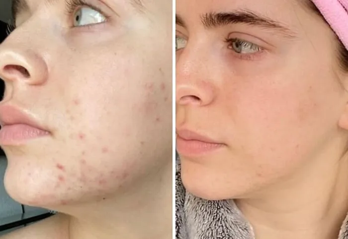 Fresh Face, No Trace With <span Style="Font:inherit;color:#d74b1f;"> Clean Skin Club Towels</Span> - Softness Unleashed!