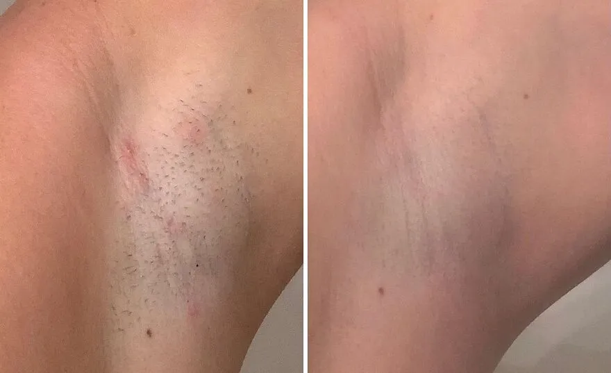 Bye-Bye Razor Bumps: Get Flawless With <span Style="Font:inherit;color:#d74b1f;"> Fab's Aha + Bha Ingrown Hair Pads</Span>!
