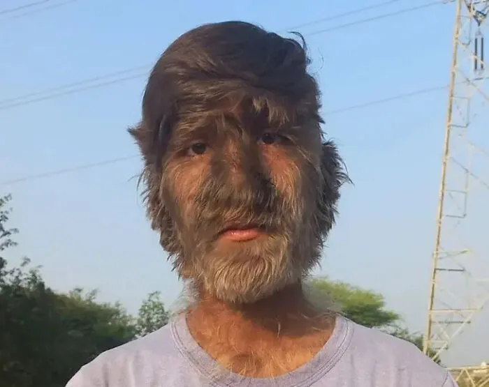 Adolescente de India con el síndrome del hombre-lobo (hipertricosis)
