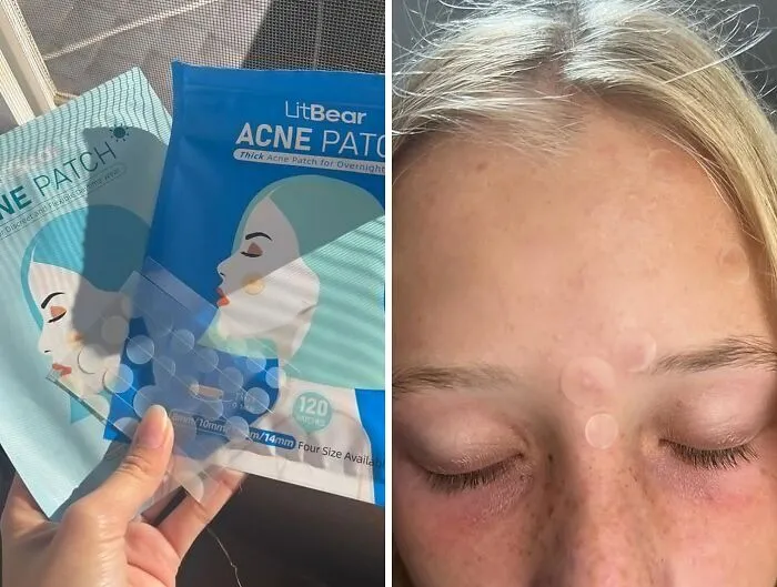 Kiss Blemishes Goodbye With <span style="font:inherit;color:#d74b1f;"> LitBear Acne Pimple Patches</span> - Your 24/7 Skincare Warrior In The Battle Against Zits!