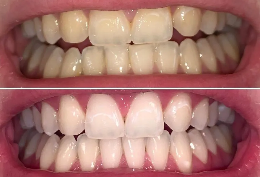 Flash That Bright Smile: <span Style="Font:inherit;color:#d74b1f;"> Crest 3D Whitestrips Vivid Plus</Span> Works Wonders!