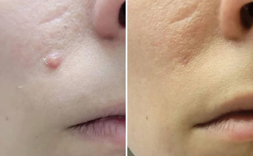 Spot On: <span Style="Font:inherit;color:#d74b1f;"> Mighty Patch</Span> Tackles Pimples With Superhero Strength!