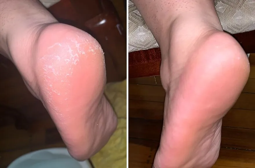 Peel The Deal: <span Style="Font:inherit;color:#d74b1f;"> Freeman Flirty Feet Spray</Span> - For Sandal-Ready Soles!