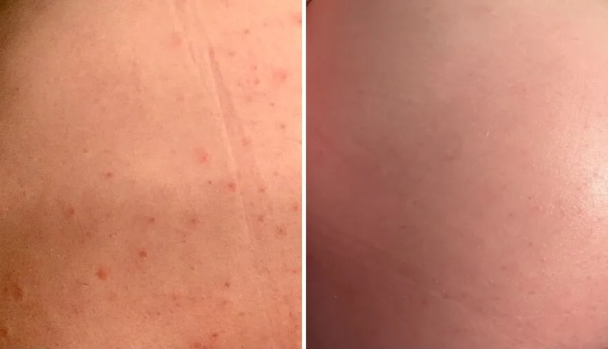 Booty Bliss: Balance & Beautify Your Butt With <span Style="Font:inherit;color:#d74b1f;"> Acne-Clearing Lotion</Span>!