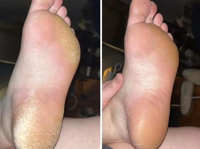 Feet Reborn: Say Goodbye To Calluses With <span Style="Font:inherit;color:#d74b1f;"> Lee Beauty Professional Remedy</Span>!