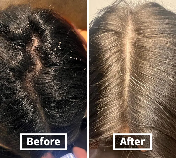 Scalp So Fresh: <span Style="Font:inherit;color:#d74b1f;"> Nizoral Shampoo</Span> Kicks Dandruff To The Curb