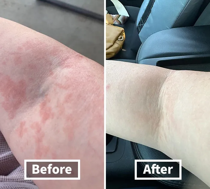 Nature’s Touch: <span Style="Font:inherit;color:#d74b1f;"> Extra Strength Tea Tree Oil Balm</Span>, Your Skin’s New Best Friend