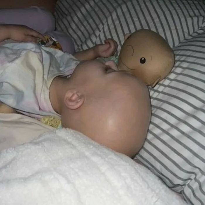 A baby with health conditions, sleeping next to an inclusive doll representing its owner.