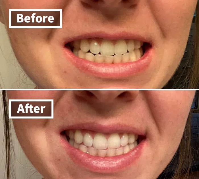 Sharpen Your Smile With The Sparkle Of 1000 Suns Using The <span Style="Font:inherit;color:#d74b1f;"> Venus Visage Award-Winning Teeth Whitening Pen</Span>. So Efficient, It's Almost Guru-Level Enchantment Compared To Crawling Through The Crest Whitening Strips Saga