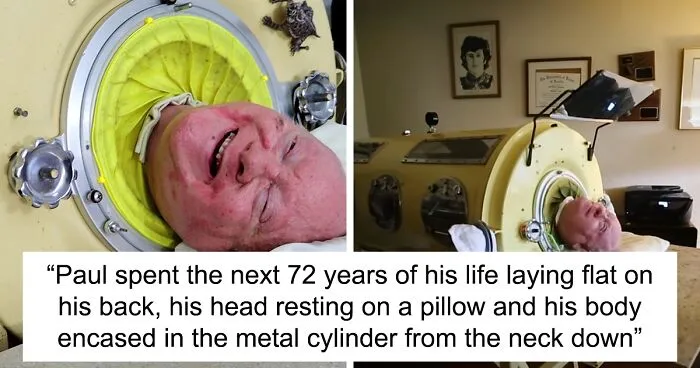 “Polio Paul” Passes Away After Spending 70 Years In Iron Lung, Leaves Impressive Legacy