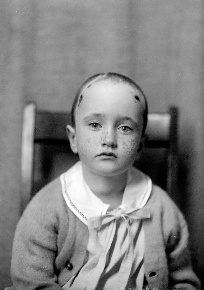 20 Haunting Medical Portraits Of Harvey Cushing's Patients In The Early 20th Century