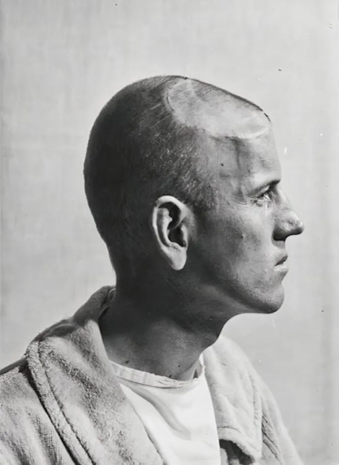 20 Haunting Medical Portraits Of Harvey Cushing's Patients In The Early 20th Century