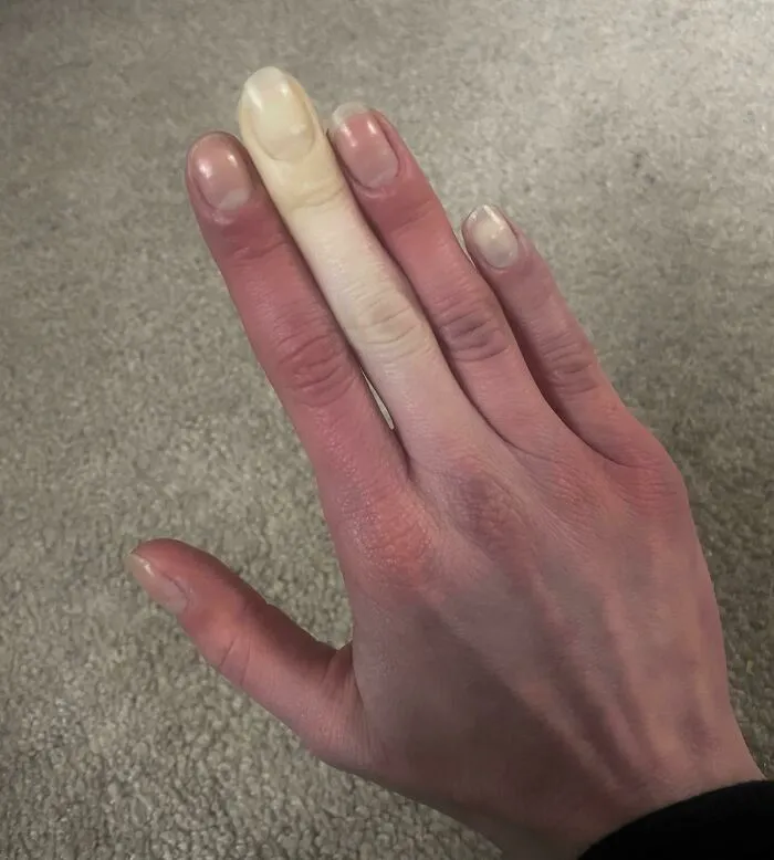 Fenómeno de Raynaud