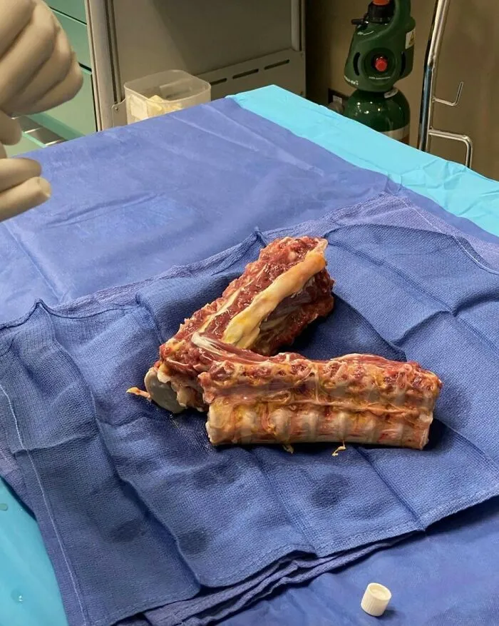 Retiran 13 cuerpos vertebrales a un donante de órganos para utilizarlos como médula ósea