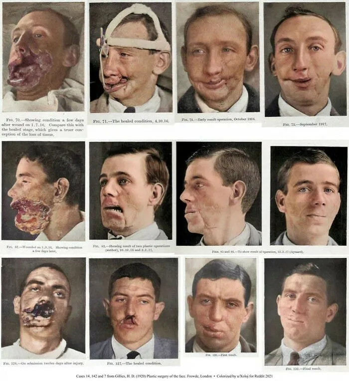 Reconstrucción facial durante la 1ª Guerra Mundial (1916-1917) [coloreadas]