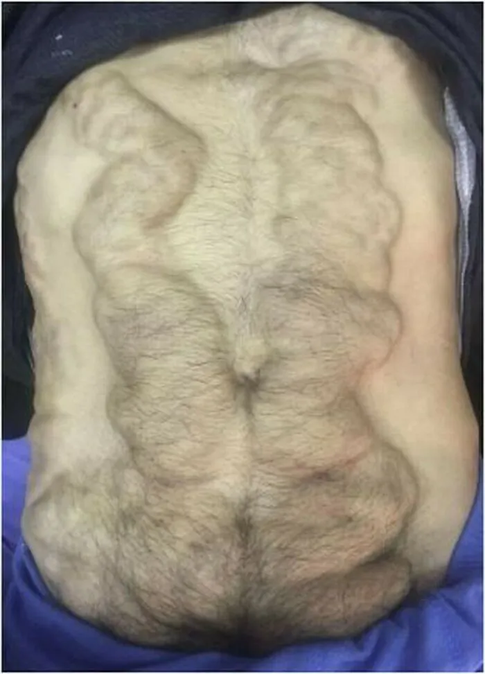 Caput Medusae. It Is The Appearance Of Engorged And Severely Distended Epigastric Veins That Usually Radiate From Umbilicus Around The Abdomen. It Is Also Called Palm Tree Sign And Is Cardinal Sign Of Portal Hypertension