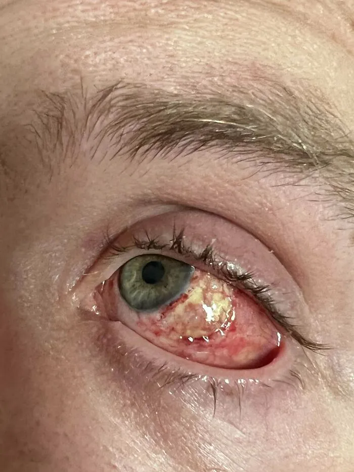 Mi hermano fue operado de un melanoma en el ojo