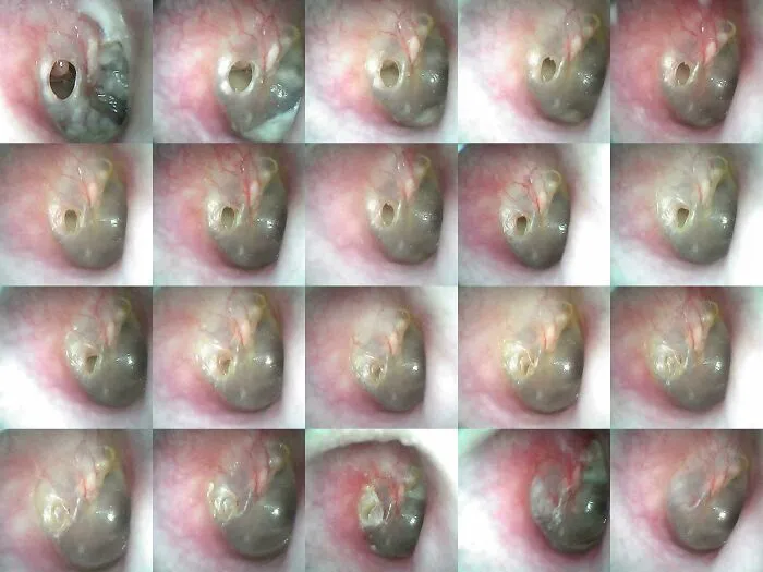 Una infección grave resistente a los antibióticos me provocó la rotura del tímpano. Compré un otoscopio digital y tomé una foto cada dos días mientras se curaba.