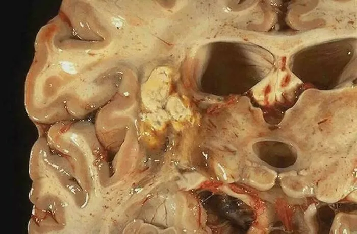 Cross-section of a human brain showcasing an interesting medical case, highlighting complexity and resilience.