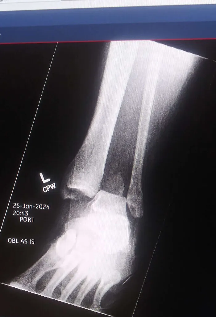 X-ray image of a human foot showing bone structure and a fracture, highlighting an interesting medical case.