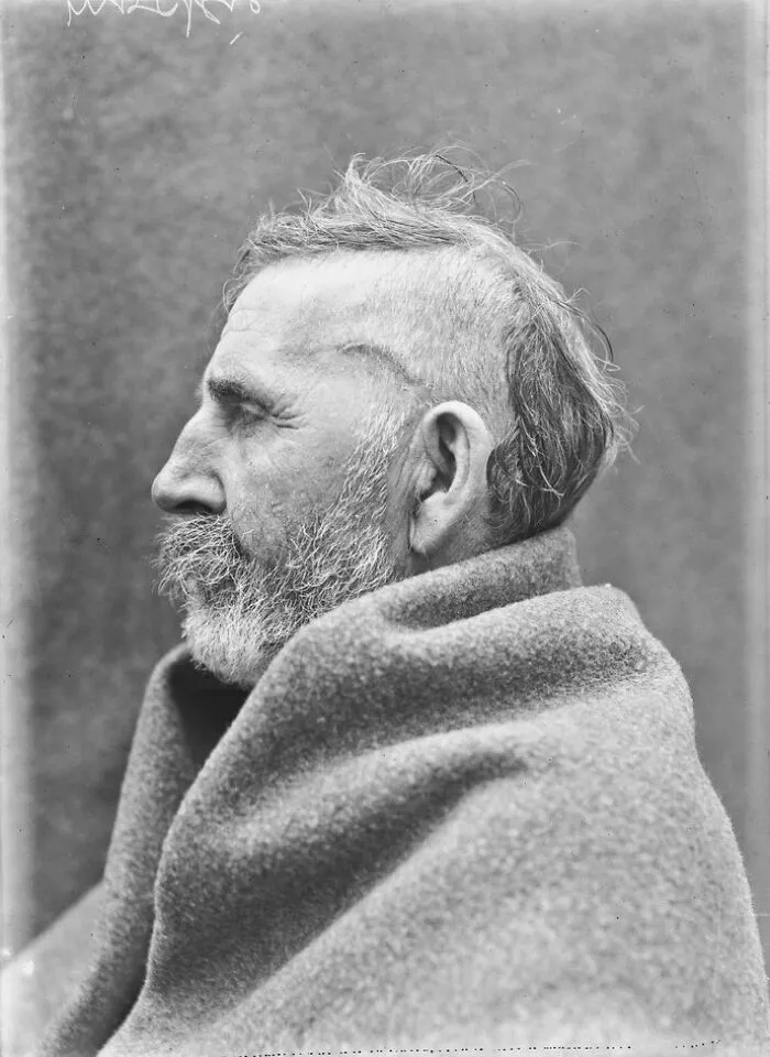 20 Haunting Medical Portraits Of Harvey Cushing's Patients In The Early 20th Century