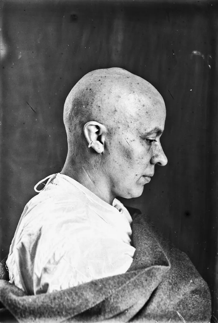 20 Haunting Medical Portraits Of Harvey Cushing's Patients In The Early 20th Century
