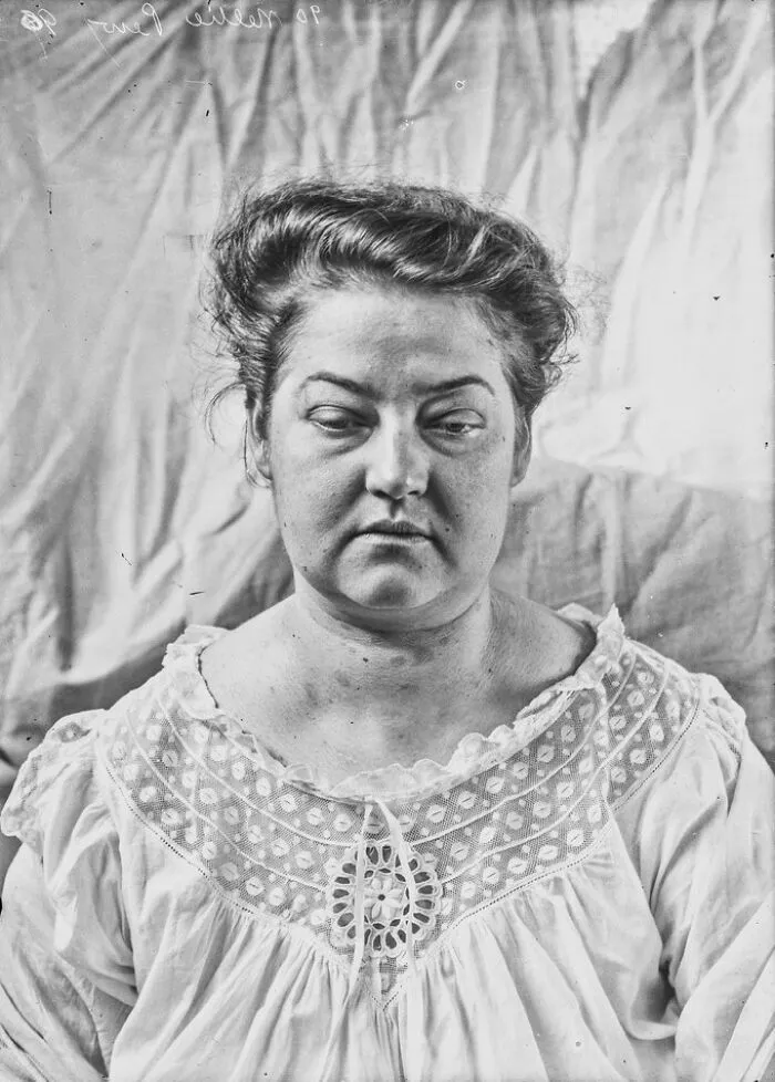20 Haunting Medical Portraits Of Harvey Cushing's Patients In The Early 20th Century