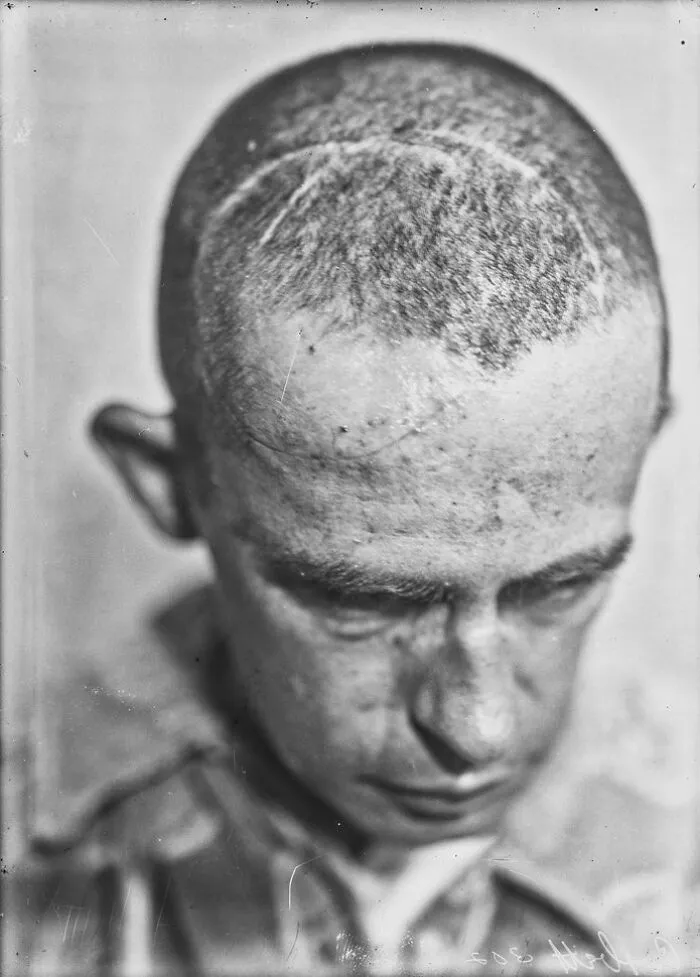 20 Haunting Medical Portraits Of Harvey Cushing's Patients In The Early 20th Century