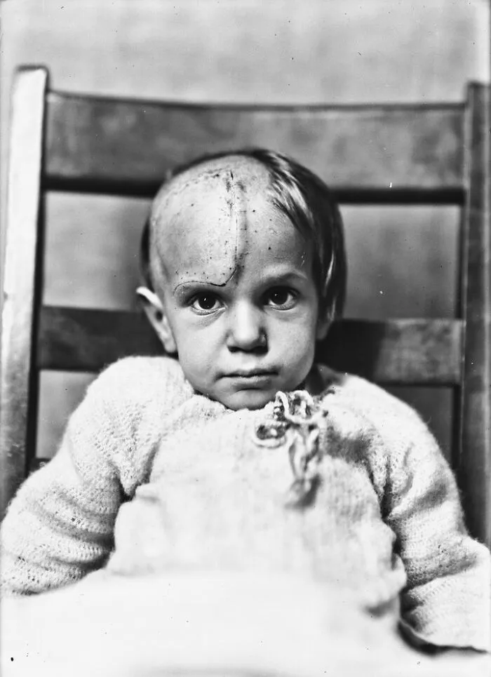 20 Haunting Medical Portraits Of Harvey Cushing's Patients In The Early 20th Century