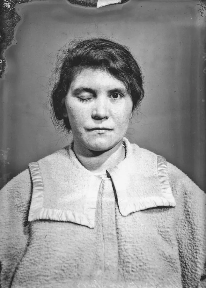 20 Haunting Medical Portraits Of Harvey Cushing's Patients In The Early 20th Century