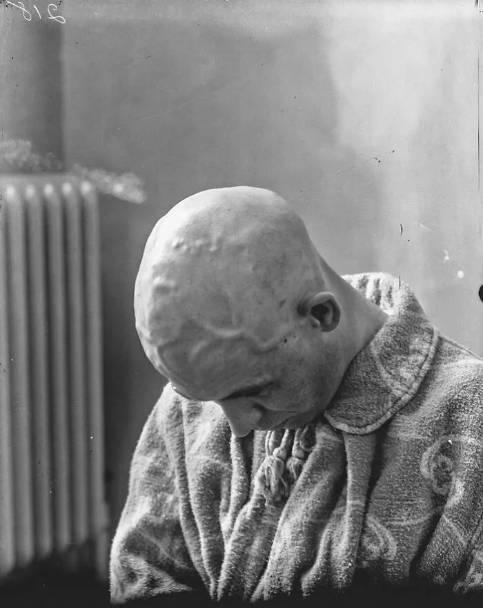 20 Haunting Medical Portraits Of Harvey Cushing's Patients In The Early 20th Century
