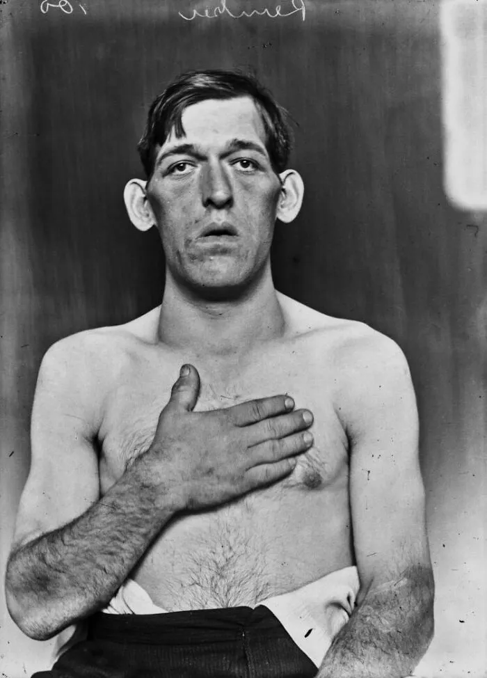 20 Haunting Medical Portraits Of Harvey Cushing's Patients In The Early 20th Century
