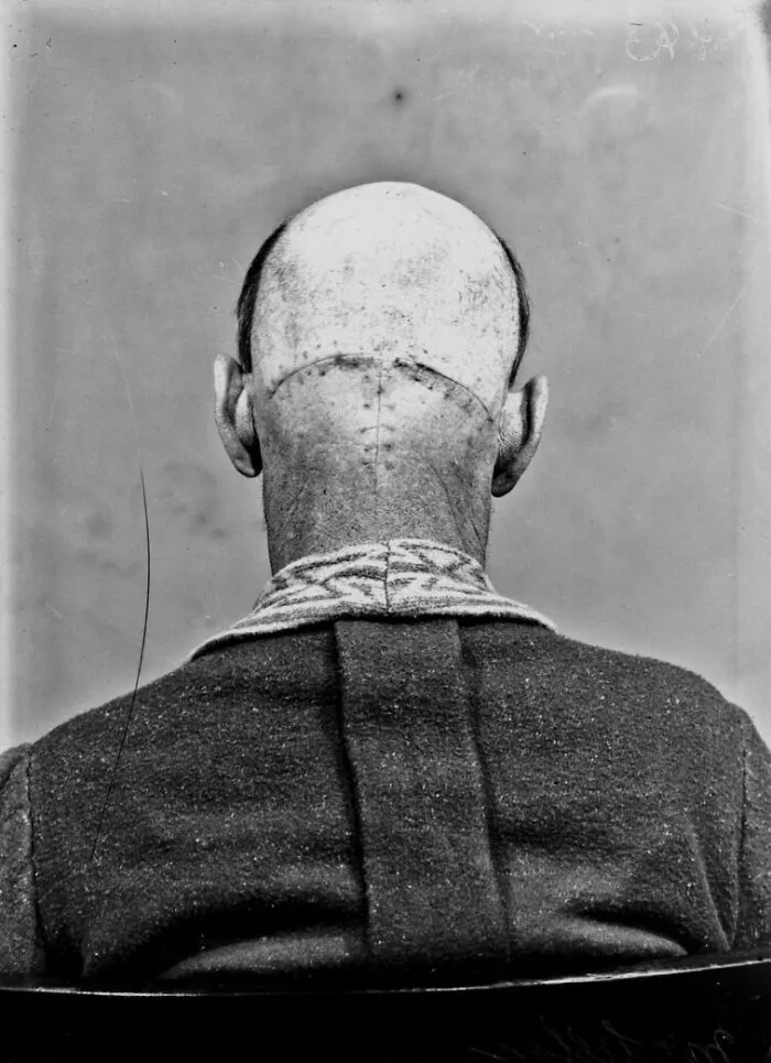 20 Haunting Medical Portraits Of Harvey Cushing's Patients In The Early 20th Century