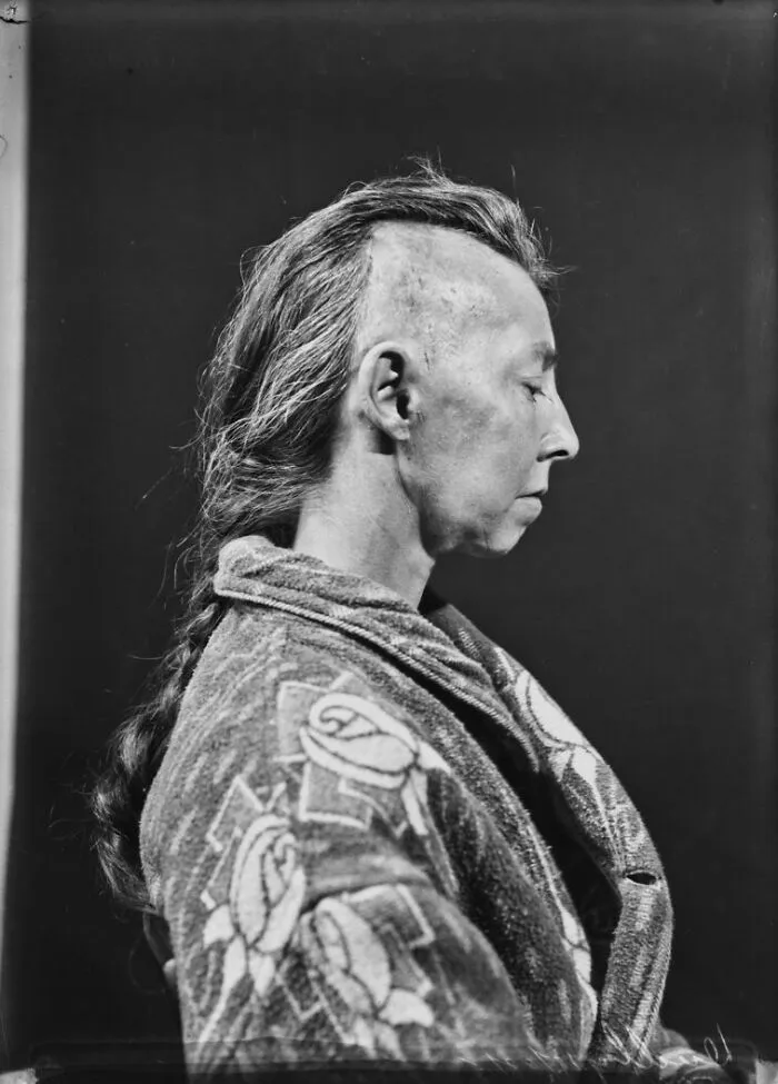 20 Haunting Medical Portraits Of Harvey Cushing's Patients In The Early 20th Century