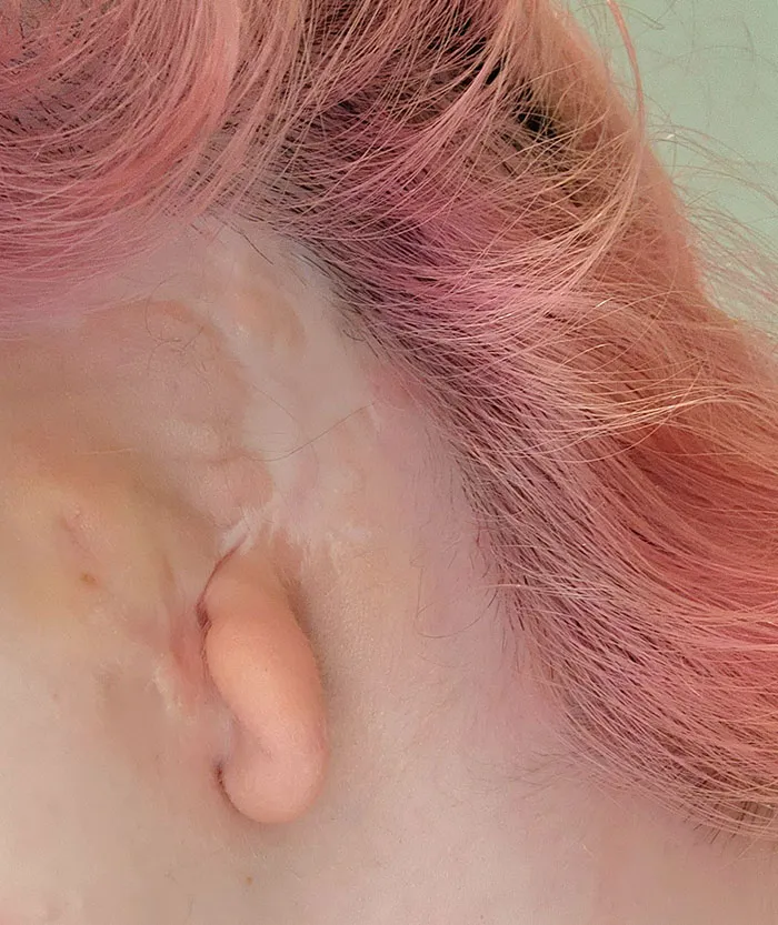 Nací sin el resto de mi oreja
