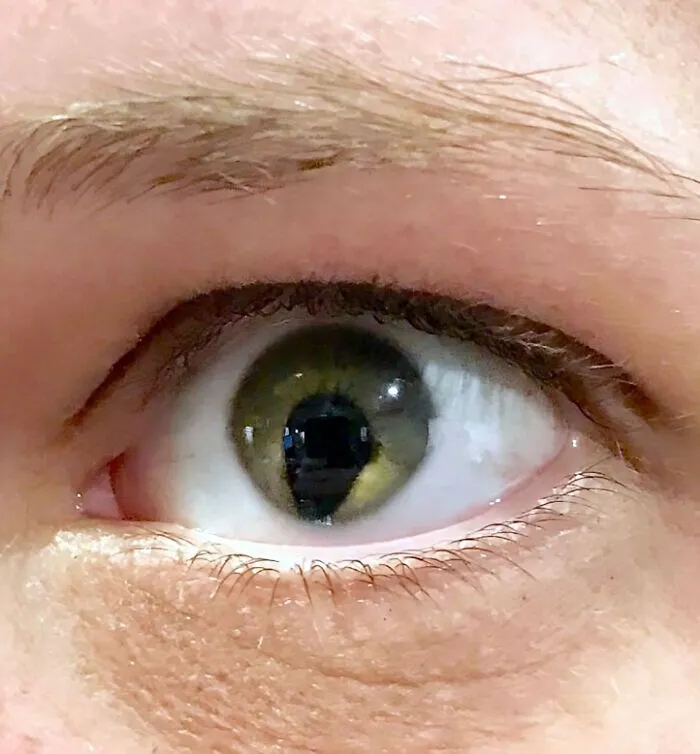 Tengo un agujero en la estructura del ojo, un coloboma