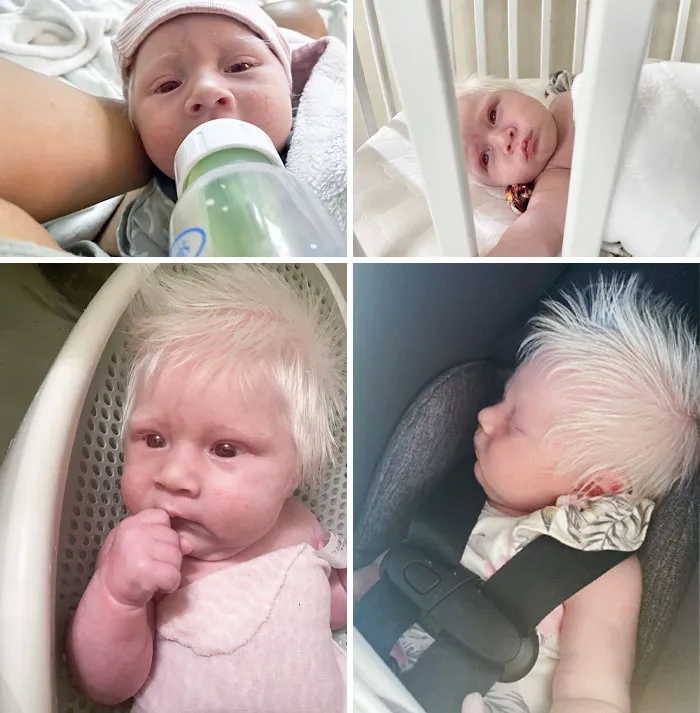 Mi niña ha nacido con albinismo y es preciosa