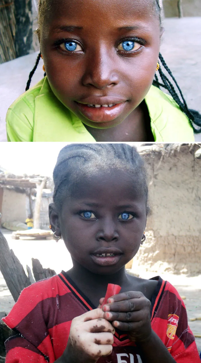 Ojos azules increíbles. Niña con el síndrome de Waardenburg