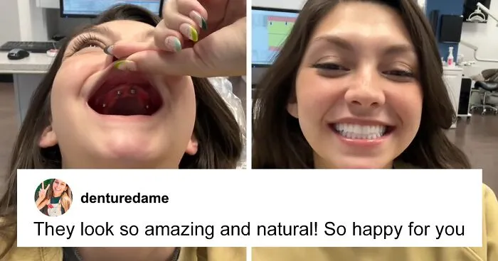 After Having All Her Teeth Pulled Out At 20, Woman Shares “Before/After” Implants Transformation