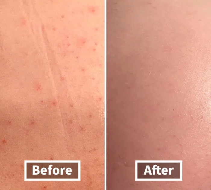 Say Bye To Blemishes: Rock A Bump-Free Booty With <span Style="Font:inherit;color:#d74b1f;"> Butt Acne Clearing Lotion</Span>!
