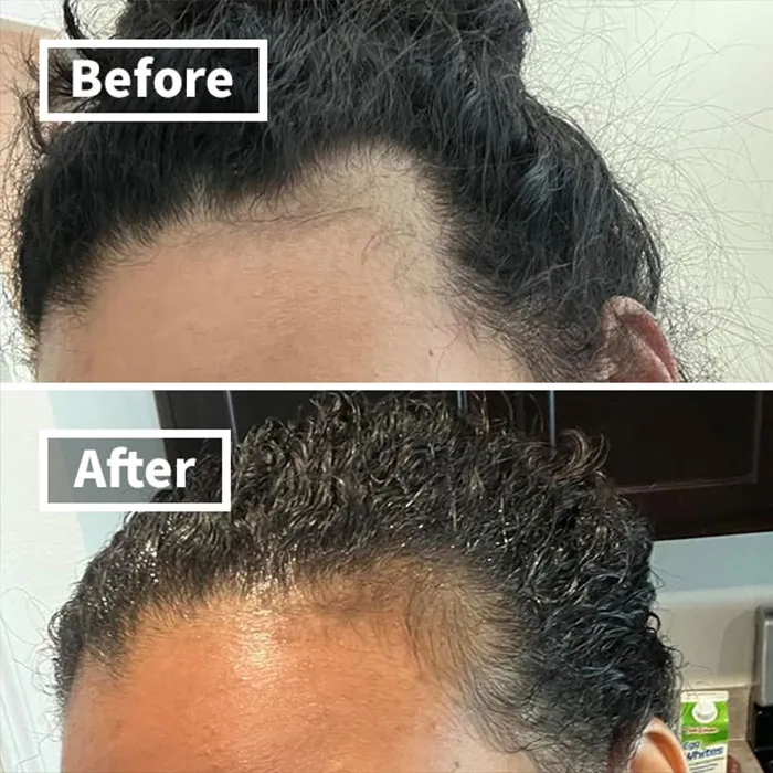 "Hair growth product before and after results, ideal for Mother's Day gifts under $20."