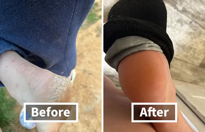 Heel The Pain Of Dry, Cracked Skin With The Nourishing <a Style="Display:inline;" Href="Https://Www.amazon.com/Dr-Fredericks-Original-Moisturizing-Treatment/Dp/B0clrkbltr?crid=2tw9660v1z119&dib=eyj2ijoimsj9.9shwmqjq0tkik8zmlgkjon6ru3h4mm_ivc6rtan37qade6jrxuuwll6o_hcz5r7px8mgrndzuseo1aglpdqzyrbkagjveyis5aiugpligxuqbnsdyo0mhseg4jwygjyisz4_rfrxptsr-Orwmel9uab7knylh0njarizm16kcr8houtrokdlg3hg0dkgojxhmgddv4s3adsd_9vhi45zzsbglwguuxzgldtljp-Sf33tc0gug7d_rlthpp3eeuzfmzgpfhbha8nl0v67anljwzw-Jj0eyevgpuphfsyccce.ary4oei3p4nwhtu2k_x6snnxu2nld_bpnfkid3ayinc&dib_tag=se&keywords=women+essentials&qid=1712317150&sprefix=women+esse%2caps%2c196&sr=8-56&linkcode=ll1&tag=bpsparrow-20&linkid=95e5e88f3a9d232f72c79fbe03cf7ffe&language=en_us&ref_=as_li_ss_tl" Target="_blank"> <span Style="Font: Inherit; Color: #d74b1f;"> Dr. Fredericks Moisturizing Treatment </Span> That Softens And Smooths Even The Toughest Heels, Making Sandals Season A Whole Lot More Enjoyable