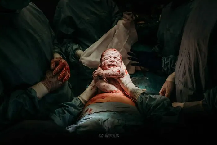Honorable Mention: "Her Baby, Her Birth, Her Way (Maternal Assisted Caesarean)", Inge Berken, Netherlands