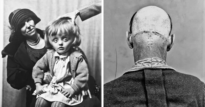 20 Haunting Medical Portraits Of Harvey Cushing's Patients In The Early 20th Century