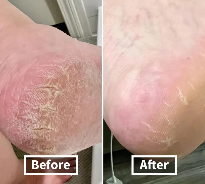Pamper Your Feet With <a Style="Display:inline;" Href="Https://Www.amazon.com/Dp/B08yzbbvgk?ascsubtag=7634304%2c17%2c35%2cd%2c0%2c0%2c0%2c900%3a2%3b974%3a2%3b1125%3a3%3b1242%3a1%2c44148574%2c0%2c0%2c0&linkcode=ll1&tag=bpcobra-20&linkid=680c40a95270deb9555ea5c4be6091ad&language=en_us&ref_=as_li_ss_tl" Target="_blank"><span Style="Font: Inherit; Color: #d74b1f;"> Dr. Scholl's Heel Repair Balm</Span> And Say Goodbye To Dry, Cracked Heels. Your Feet Will Thank You, Especially After All Those Holiday Parties!