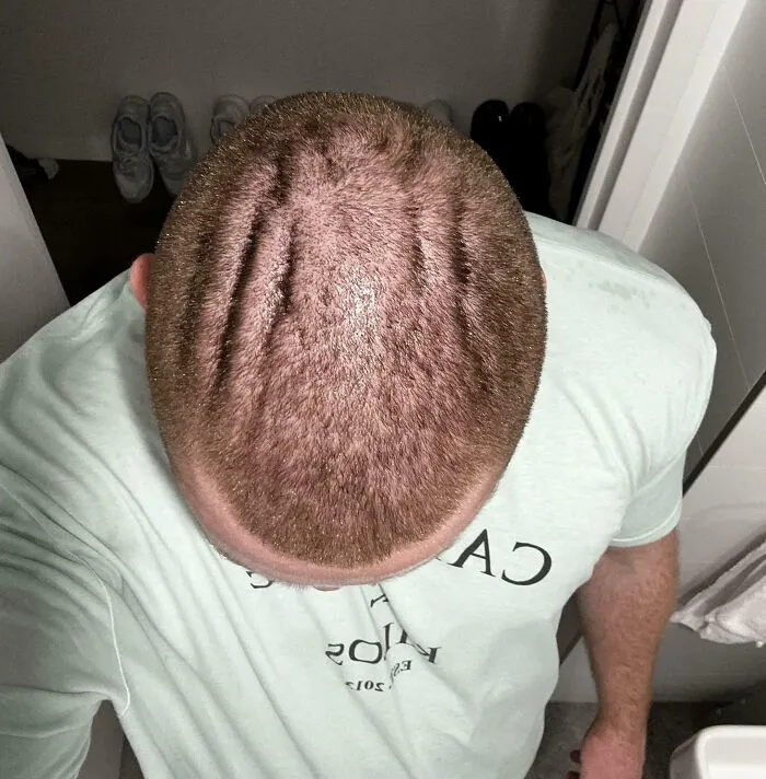 Me afeité la cabeza y resulta que tengo líneas raras