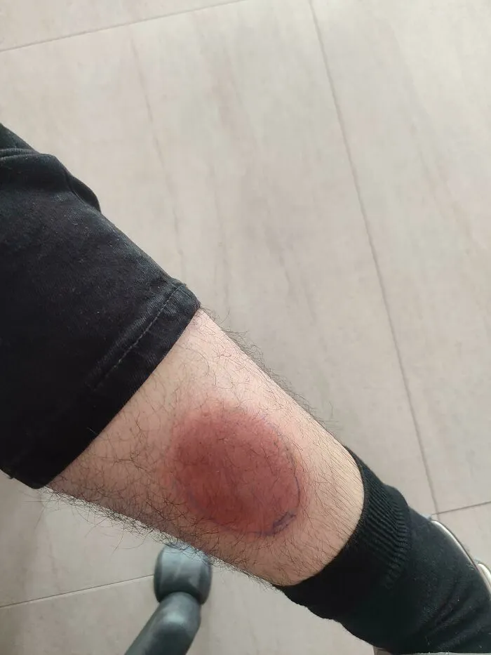I Woke Up With This On My Leg