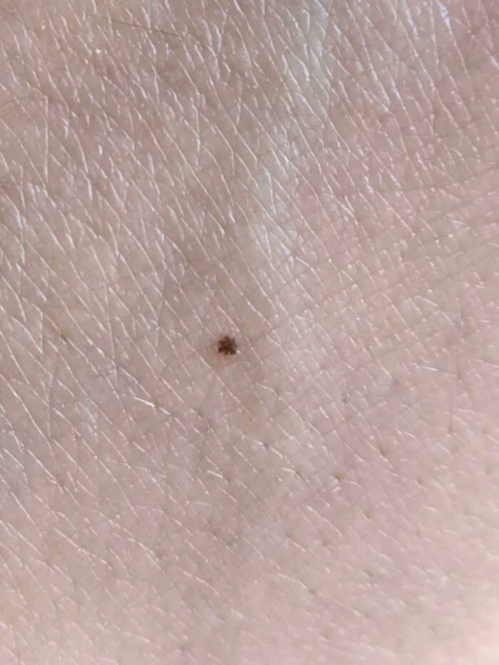 Esta peca diminuta en mi mano parece un asterisco