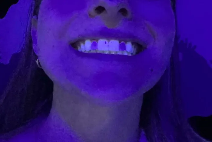 Mis coronas de porcelana no brillan bajo la luz negra como el resto de mis dientes