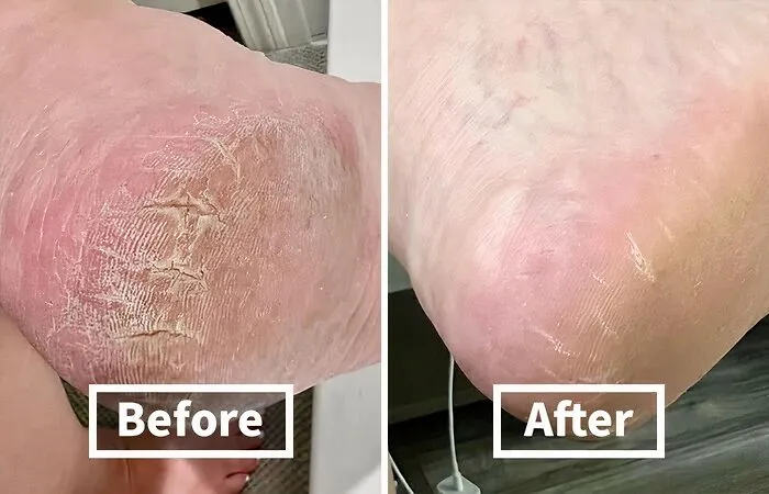 Grab Some <span Style="Font:inherit;color:#d74b1f;"> Severe Cracked Heel Repair Restoring Balm </Span> If You Find Yourself Needing Heavy Duty Equipment For A Pedicure